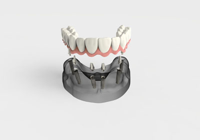 Keep Your Dentures In Your Mouth With Implant Supported Dentures Smiles By Design Pc Huntsville Alabama